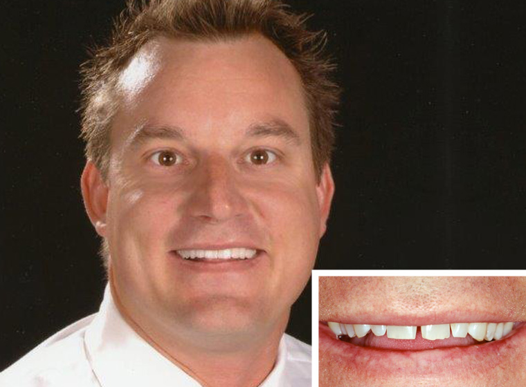 before and after porcelain veneers from Oceanside Dental Excellence