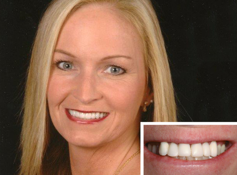 real results from dental veneers at Oceanside dentist